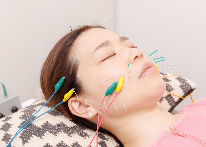 フェイス鍼 イメージ